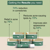 Aaryanveda - Acnend Oil Control Facial Kit - 260gm