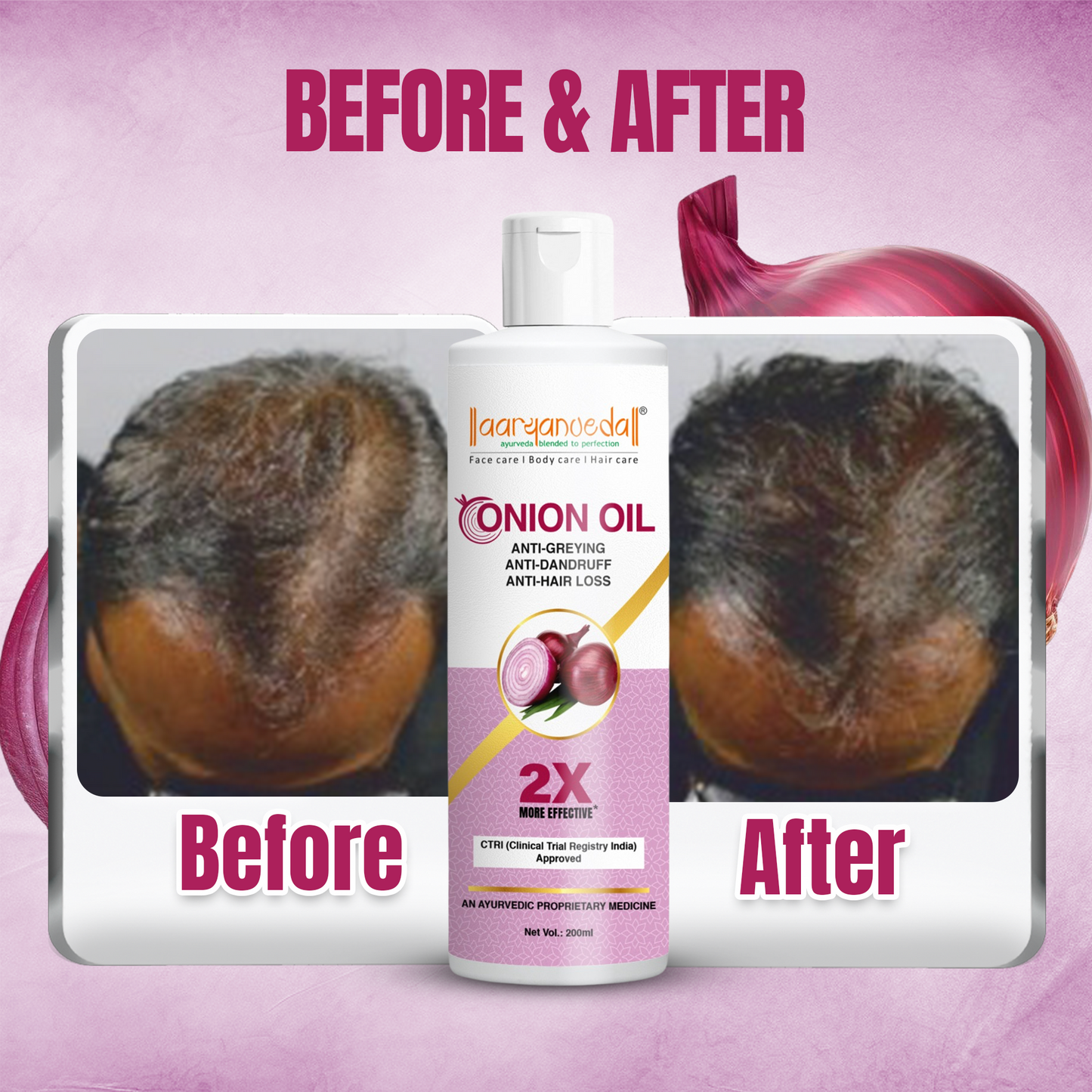 Ayurvedic Red Onion Oil For Anti-Greying & Anti-Dandruff -200 ml